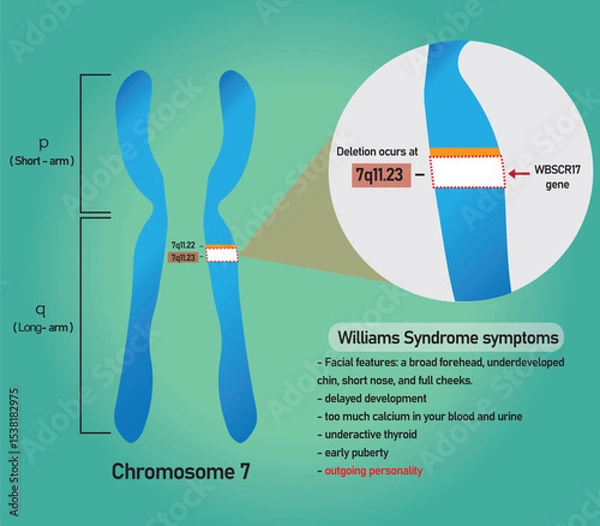Fototapeta Information infographic of Williams syndrome that's a genetic disorder resulting from the loss of multiple genes in the 7q11.23 region of chromosome 7.	