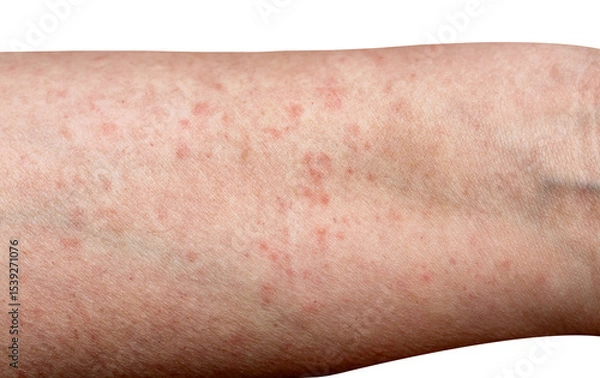 Obraz Dermatology medical concept. Female arm with allergic reaction isolated on white background. Close up shot of allergic skin irritation with red spots and rash