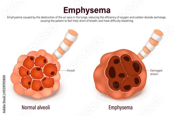 Fototapeta Emphysema. Comparison between normal alveoli and emphysema. Lung diseases anatomy. Human respiratory system.