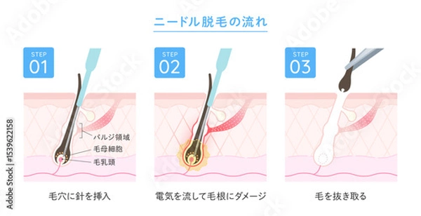 Obraz ニードル脱毛 施術の流れ