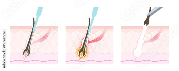 Obraz ニードル脱毛 施術の流れ