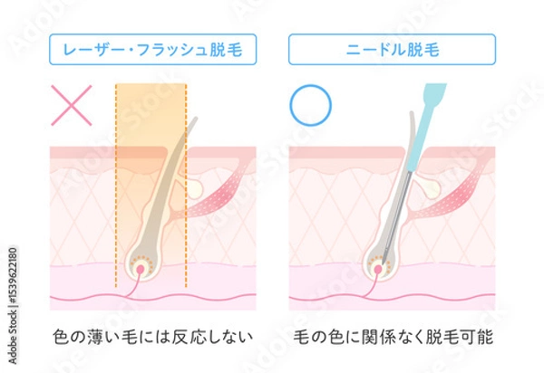 Fototapeta ニードル脱毛のメリット 毛の色に関係なく脱毛可能