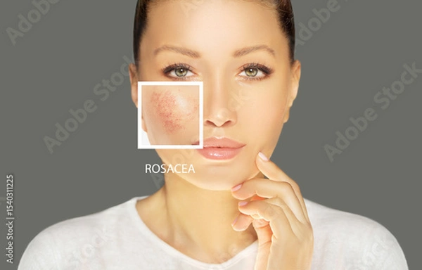 Obraz Rosacea ,facial redness.Before and after	