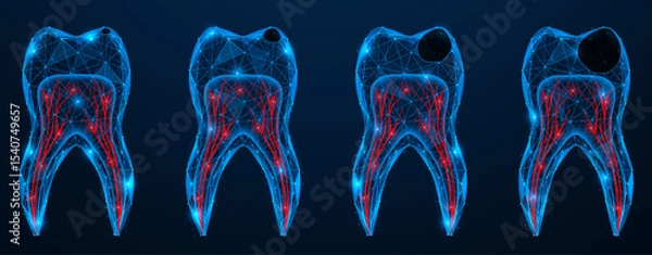 Fototapeta Caries, stages of tooth decay. Low-poly design of lines and dots. Blue background.