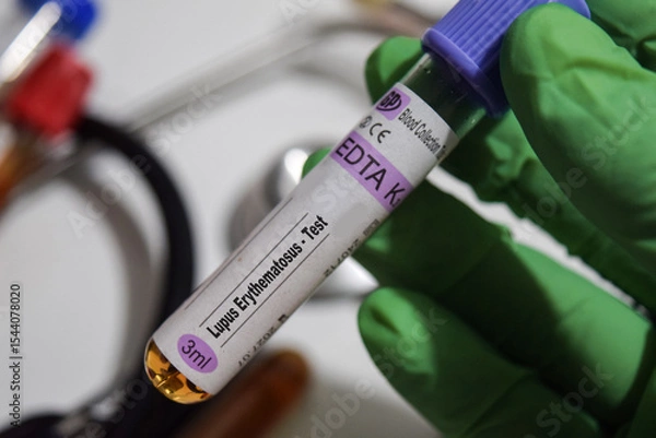 Obraz Lupus Erythematosus - Test with blood sample. Top view isolated on office desk. Healthcare or Medical concept
