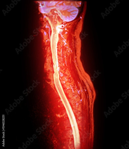 Fototapeta The MRI scan of the cervical spine shows detailed imaging of the vertebrae and spinal cord, highlighted in vibrant pink. The clear delineation of the spinal cord and vertebral structures is evident.
