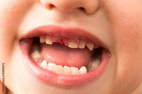 Obraz The mouth of a boy without a tooth
