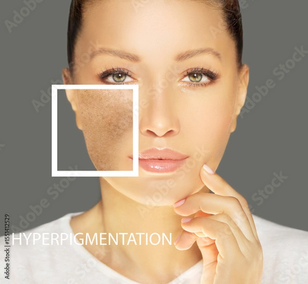 Obraz Dark spots, freckles,hyperpigmentation(melasma or chloasma),concept- skin lightening, skin whitening, Skin Brightening