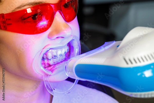 Obraz Dental whitening procedure with blue light on patient wearing red protective glasses