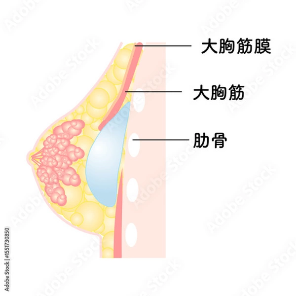 Fototapeta バッグ豊胸_デュアルプレーン法