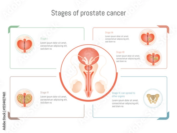 Obraz Prostate cancer stages infographic showing tumor growth