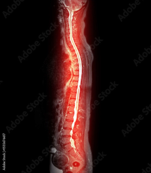 Fototapeta MRI whole spine screening for diagnosis spinal cord compression.