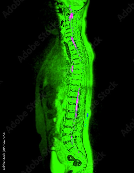 Fototapeta MRI whole spine screening for diagnosis spinal cord compression.