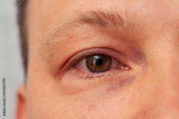 Fototapeta A close-up of an eye exhibiting symptoms of conjunctivitis, with visible redness and irritation.