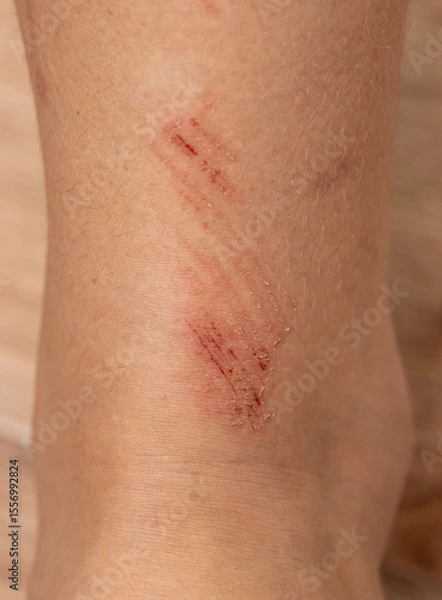 Fototapeta A person's leg has a red mark on it
