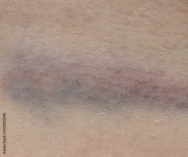 Fototapeta A person's arm with a bruise