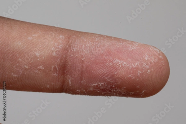 Fototapeta Dry skin showing signs of peeling on index finger