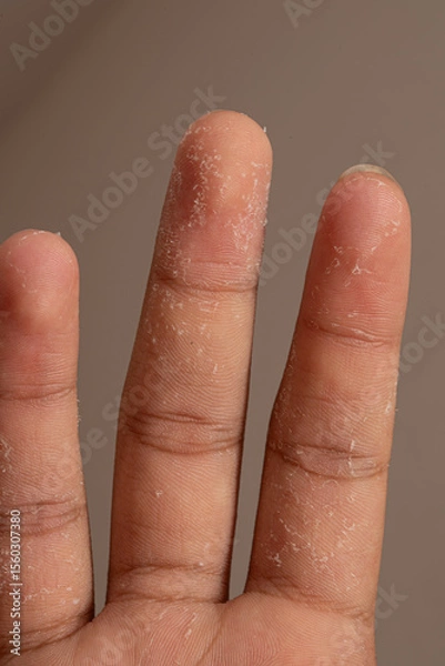 Fototapeta Dry skin showing peeling on fingers suffering from eczema