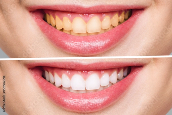 Obraz Teeth Whitening Transforming Your Appearance Before and After for Stunning Results