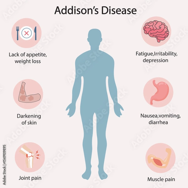 Fototapeta Flat vector illustration of Addison’s disease showing symptoms like fatigue, dark skin, depression, nausea, joint pain. Similar to adrenal insufficiency and hypothyroidism.