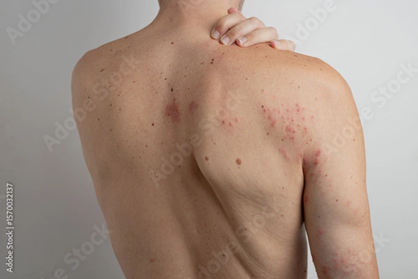 Fototapeta Caucasian man scratching his back and shoulder, suffering from chickenpox virus reactivation known as shingles or herpes zoster, causing itchy and painful red blisters