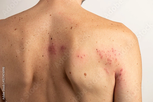 Fototapeta Close up of a man's back and shoulder exhibiting the characteristic rash and blisters of shingles, a reactivation of the varicella zoster virus, causing pain and discomfort