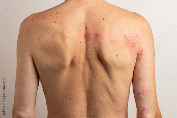 Fototapeta Patient exhibiting red blisters resulting from the reactivation of the varicella zoster virus, leading to shingles disease, characterized by a painful skin rash and discomfort