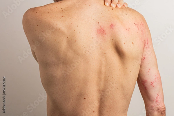 Fototapeta Caucasian man scratching his back, revealing red blisters and a rash caused by shingles, a viral infection linked to the herpes zoster virus, commonly associated with chickenpox