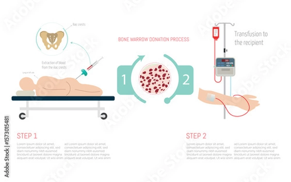 Obraz Bone marrow donation process showing extraction and transfusion