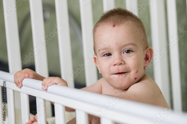 Fototapeta Toddler with Chickenpox Sitting in Bed