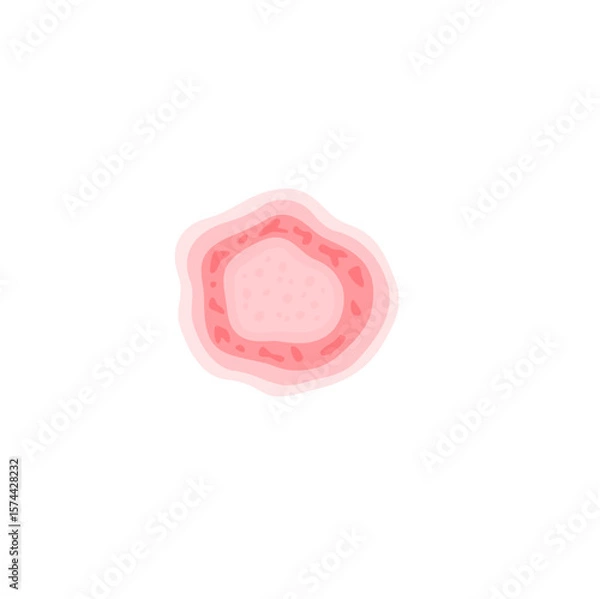 Fototapeta Dermatophytosis illustration