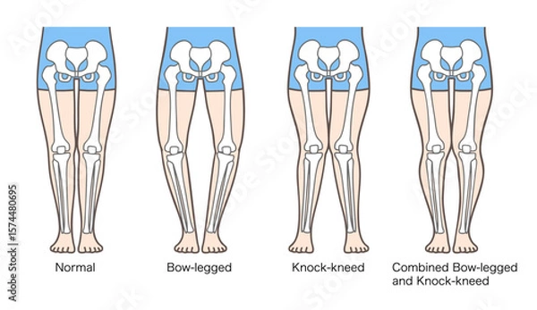 Obraz 正常な脚、O脚、X脚、XO脚の姿勢と骨格