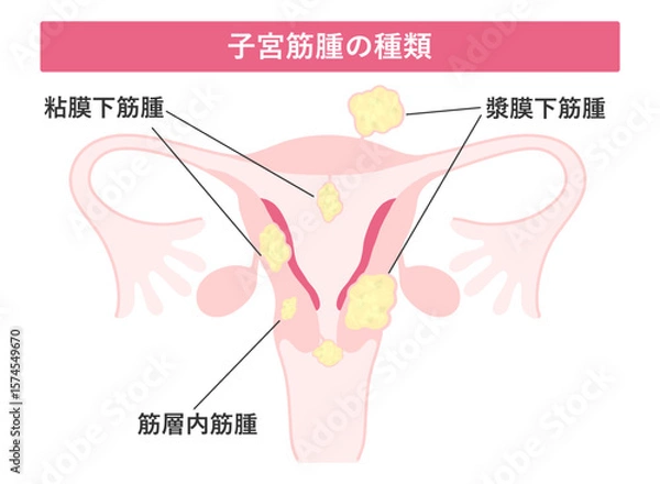 Obraz 子宮筋腫の種類