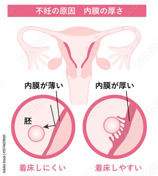 Fototapeta 不妊の原因_内膜の厚さ