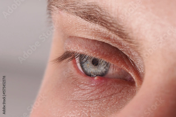 Fototapeta Ocular inflammation of barley (Hordeolum) on the lower eyelid in a man.