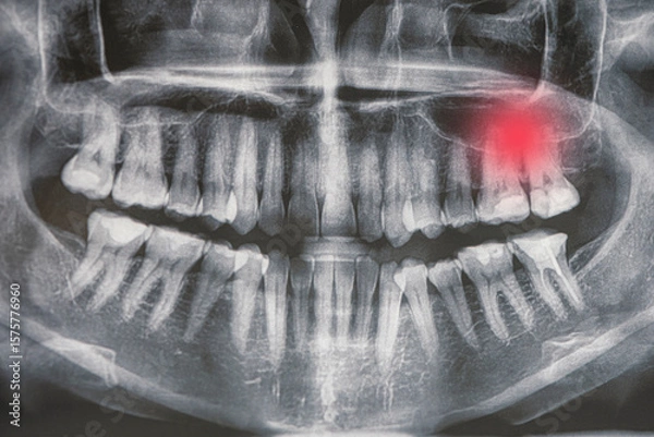 Obraz X-ray of the jaw, toothache, caries, pulpitis, gum inflammation