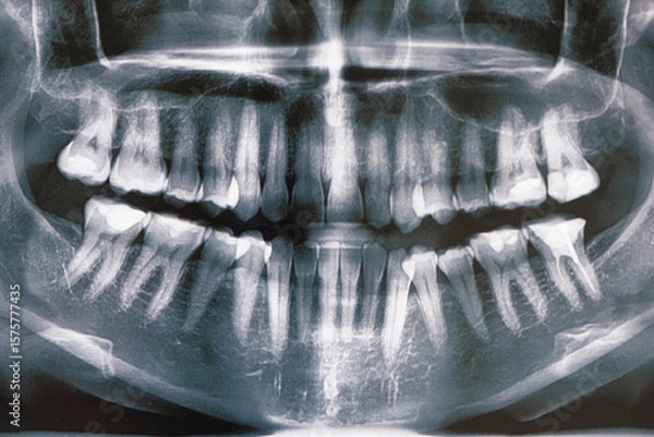 Obraz jaw X-ray, toothache, tooth care, treatment