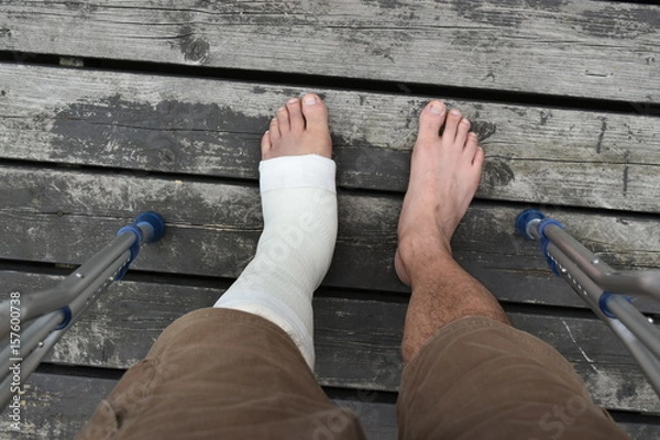 Fototapeta ギブスと松葉杖