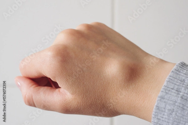 Fototapeta Female right back hand with ganglion cyst on the dorsum,  fluid-filled bump associated with a joint or tendon sheath, close-up view, selected focus.