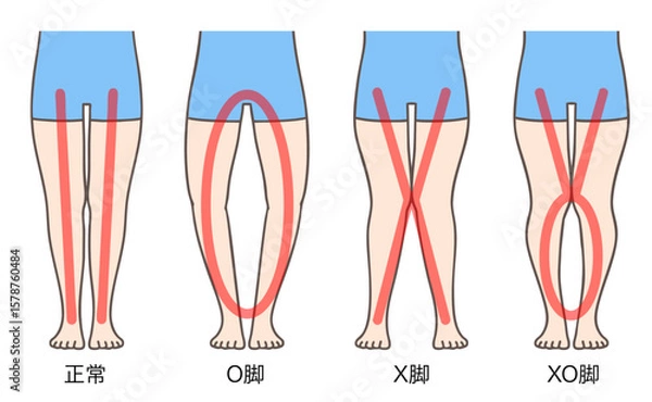 Obraz 正常な脚、O脚、X脚、XO脚、女性の下肢