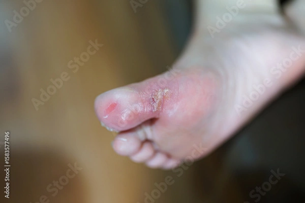 Fototapeta Elevated close-up view of a person's infected ingrown toenail on the floor 

