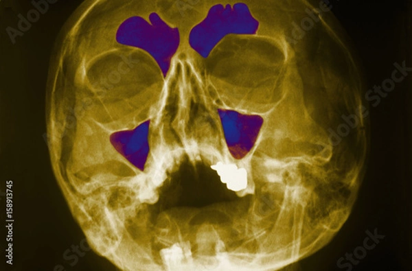 Fototapeta Sinus, x-ray