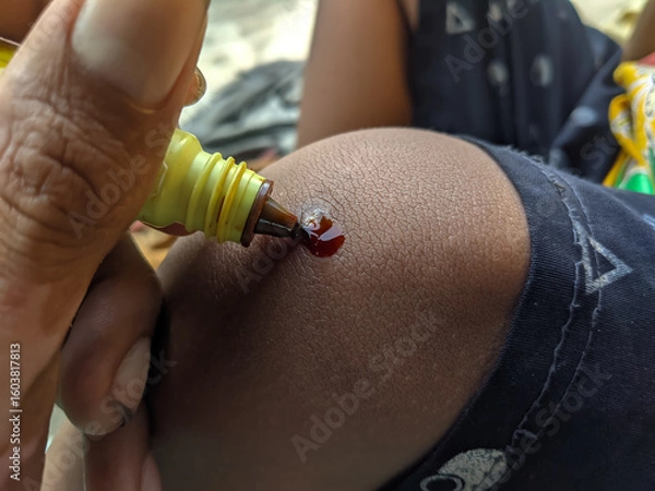 Obraz A person's hand applies brown antiseptic liquid from a yellow bottle onto a minor scrape on a child's dark skin knee. Focus on pediatric first aid.