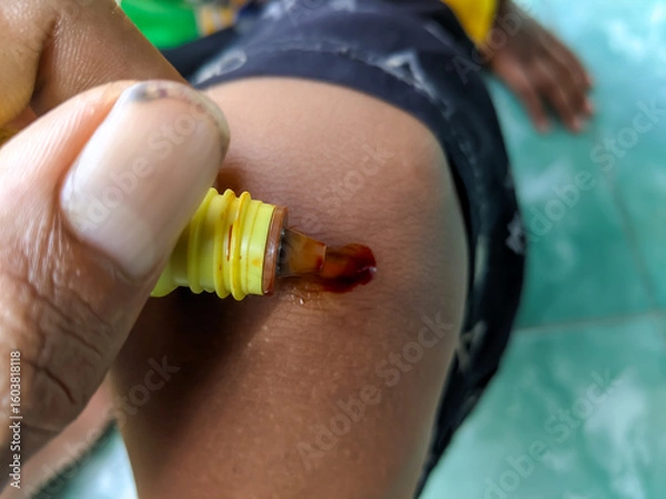 Obraz Close-up shot of a yellow tube dispensing brown antiseptic cream onto a small, open wound on brown skin, held by a slightly soiled hand. Focus on injury care.
