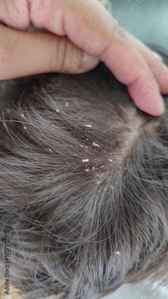 Obraz Close-up of a child's head, covered in dandruff and with red hair.