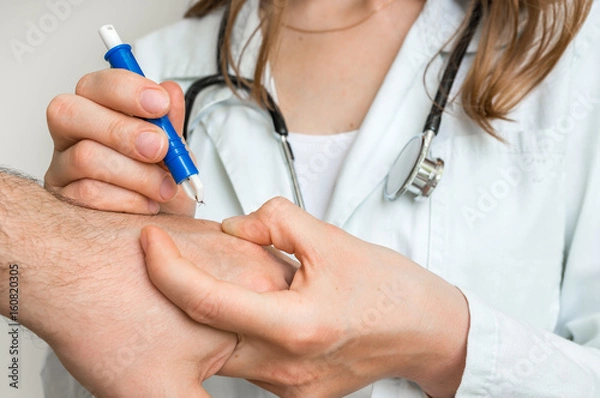 Fototapeta Doctor removing a tick with tweezers from hand of patient