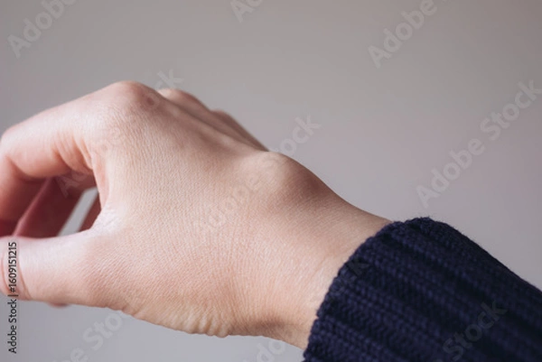 Fototapeta Female right back hand with ganglion cyst on the dorsum,  fluid-filled bump associated with a joint or tendon sheath, close-up view, selected focus.