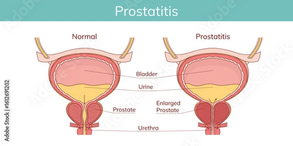 Fototapeta Benign prostatic hyperplasia (BPH). Comparison between normal prostate and enlarged prostate. Male reproductive system disease.
