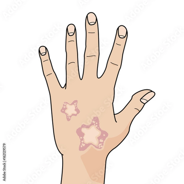 Fototapeta Hand with skin disease on white background