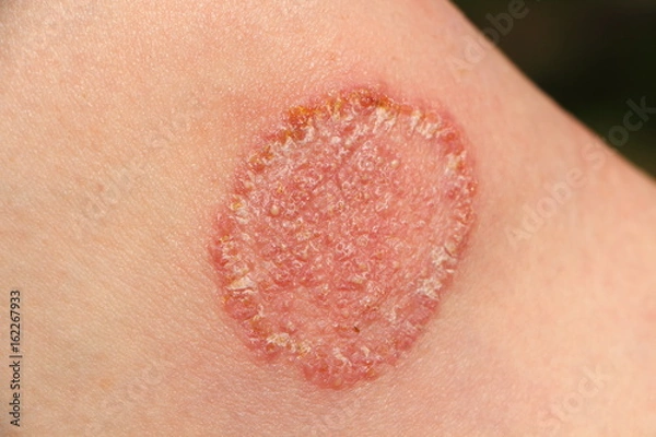 Obraz Dermatofitoza kolana